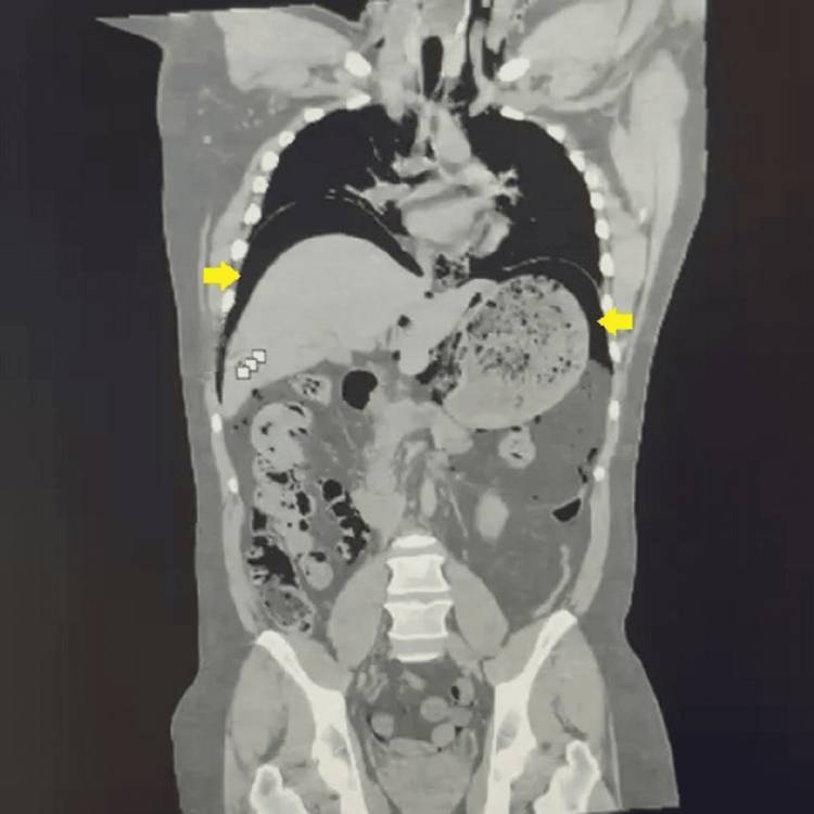 Patient CT Scan
