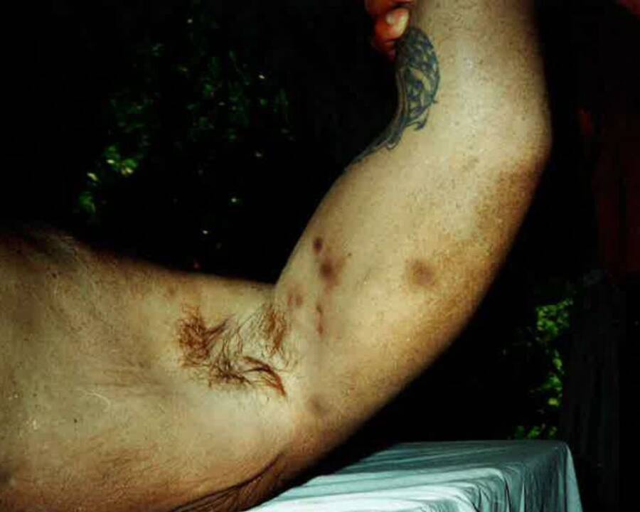 Kenneth Trentadue Arm Bruises