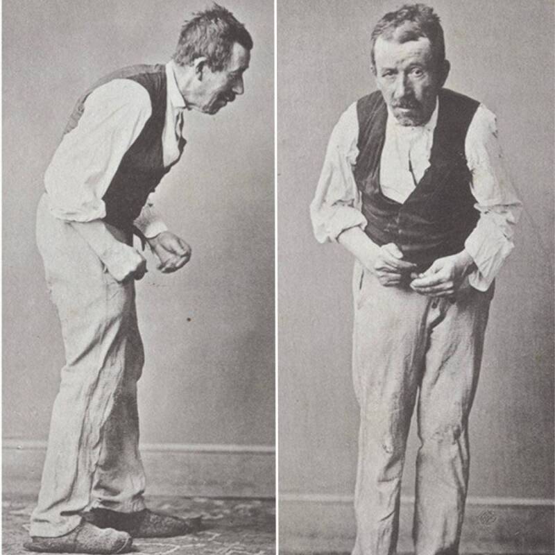 Pierre D Parkinsons Disease